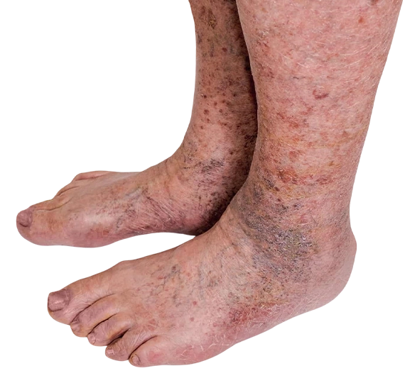 Varicose Veins South Alabama Removal 251