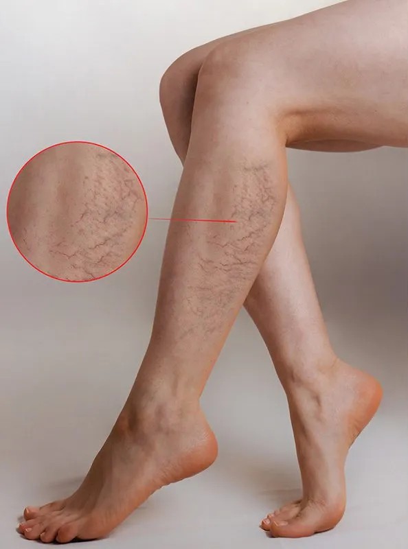 Alabama Spider Veins Doctor