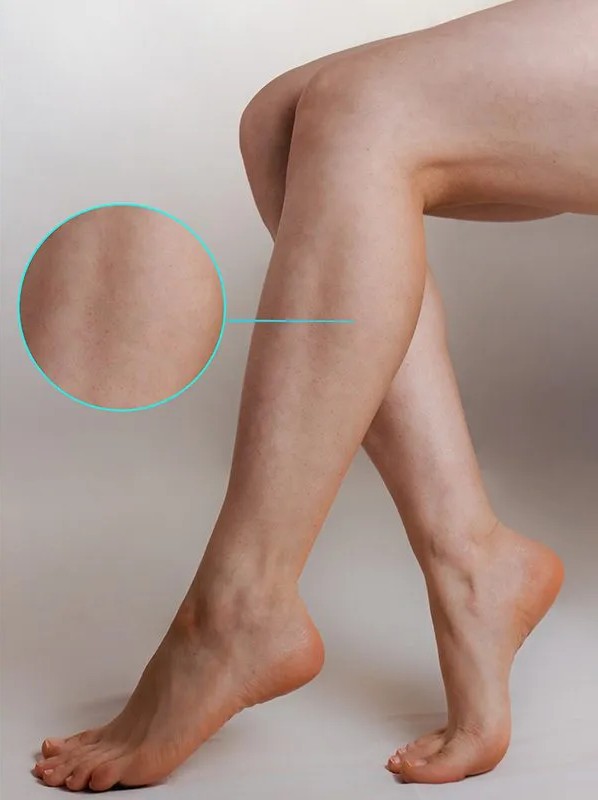 Andalusia Alabama Spider Veins Doctor