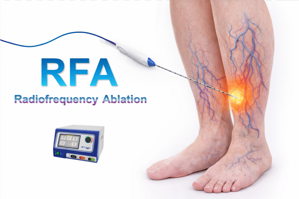 Radiofrequency Ablation (RFA) legs