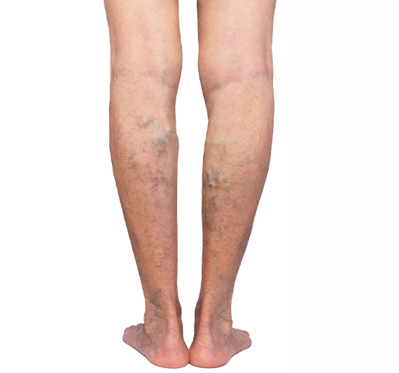 Varicose Veins Andalusia Alabama Removal