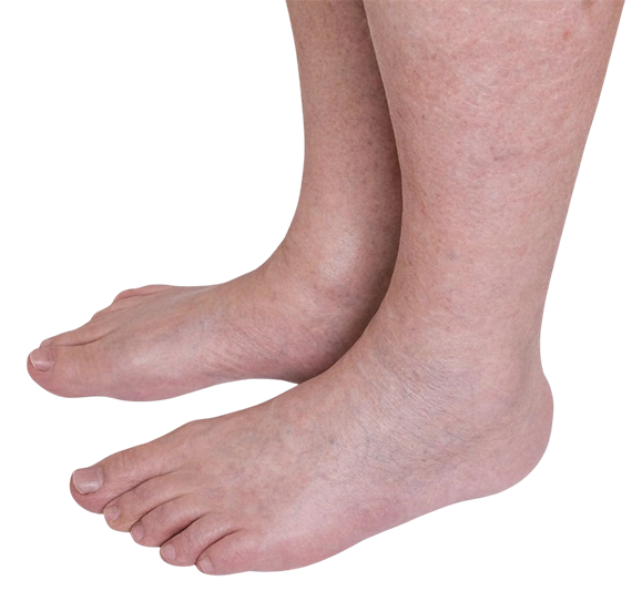 Varicose Veins South Alabama Removal 251