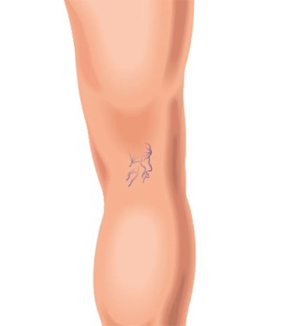 Alabama Spider Veins