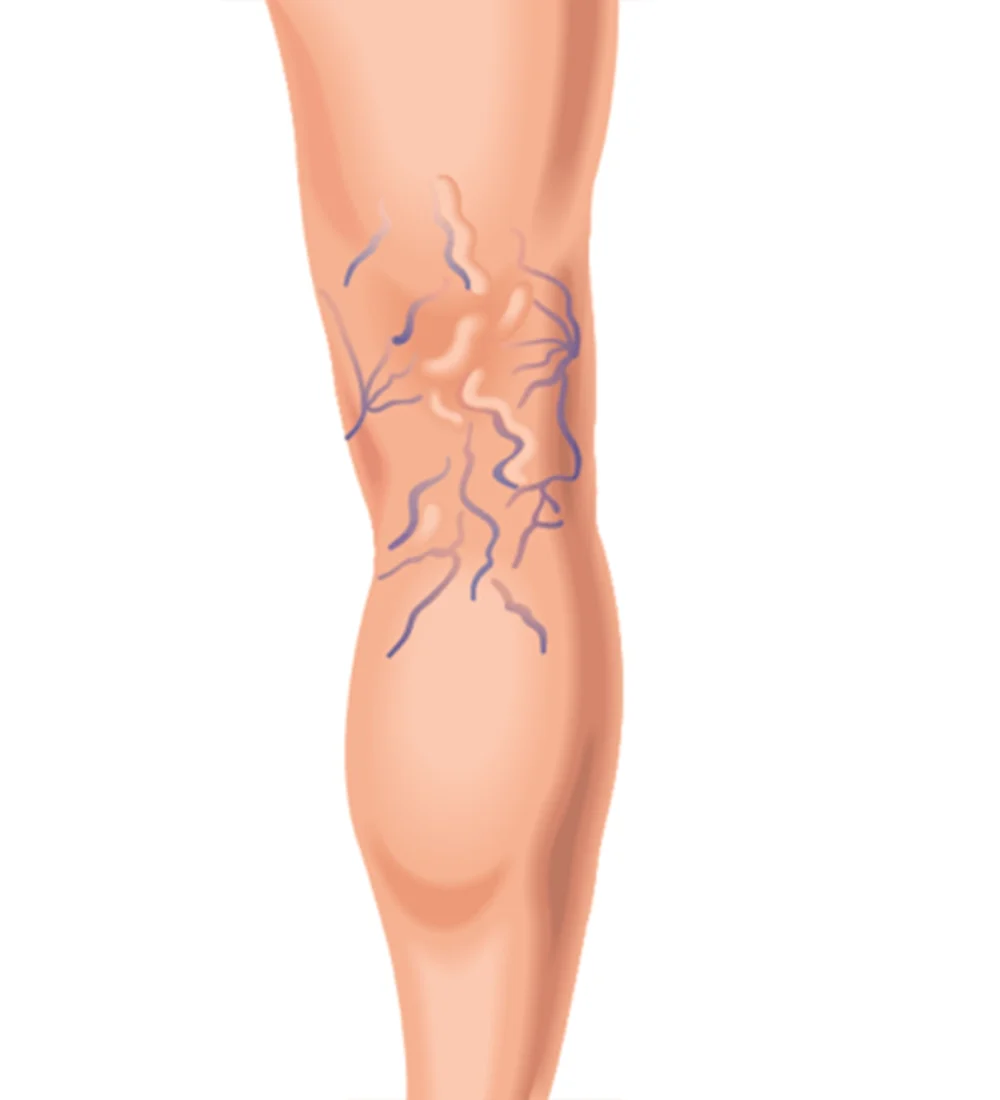Alabama Varicose Veins
