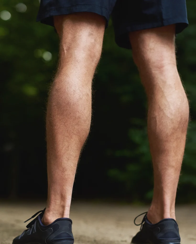 varicose vein laser treatment 251 Alabama