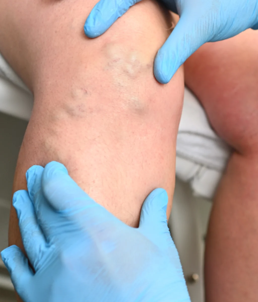 venaseal-treatment-Alabama